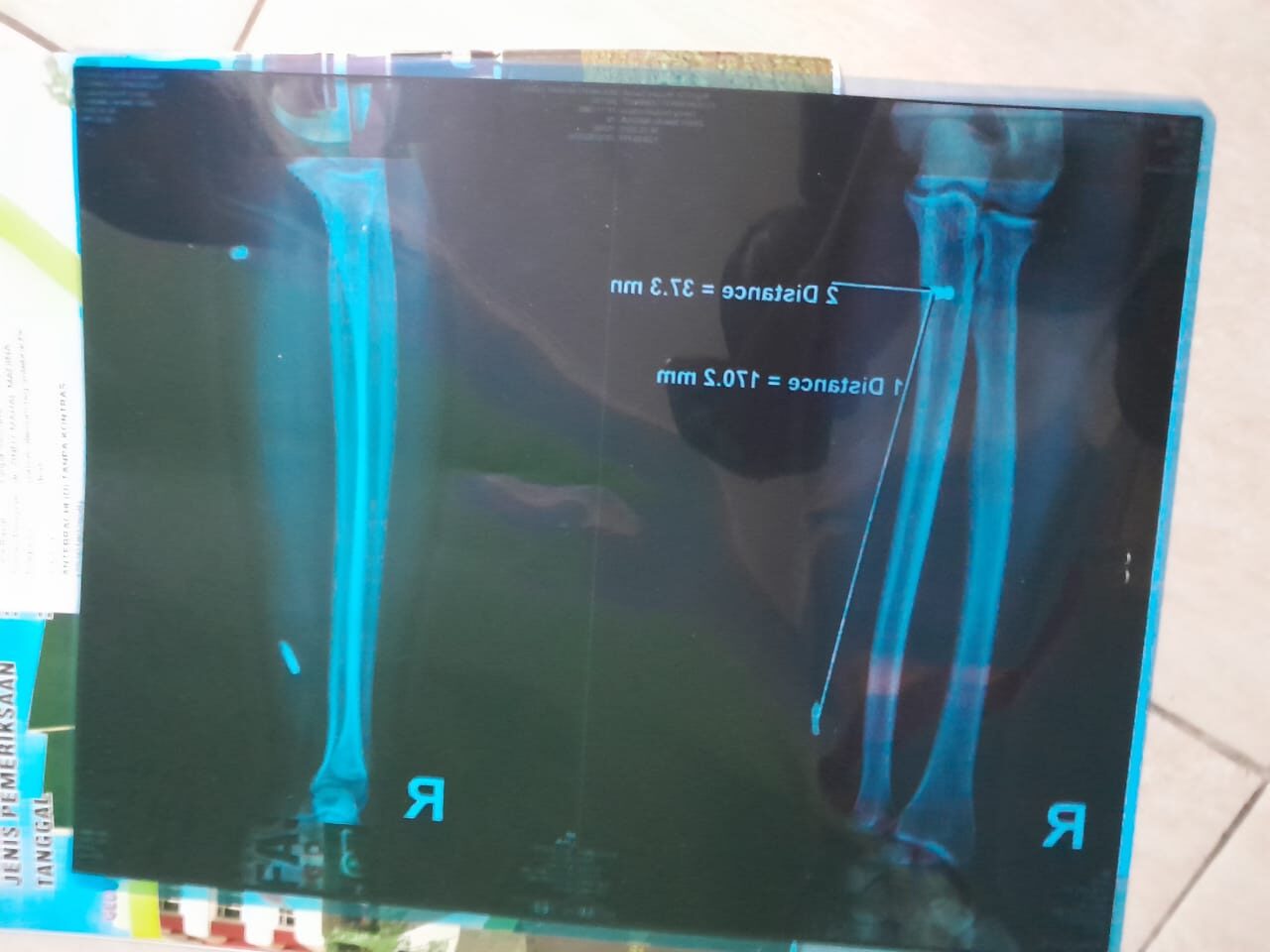 Kronologi Penembakan di Kotim: Perselisihan Pekerjaan Berakhir di UGD